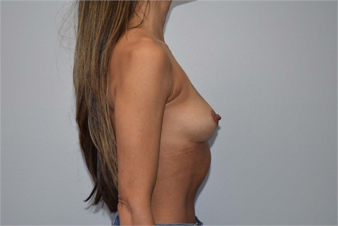 Breast Implant Removal without Breast Lift After