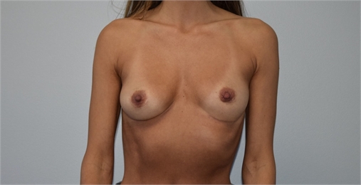 Breast Implant Removal without Breast Lift After