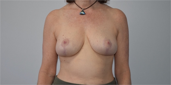 Breast Reduction After