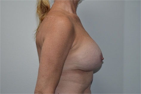 Breast Implants After