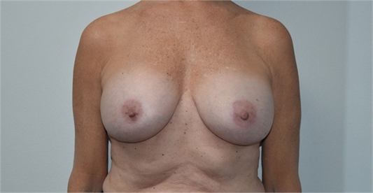 Breast Implants After