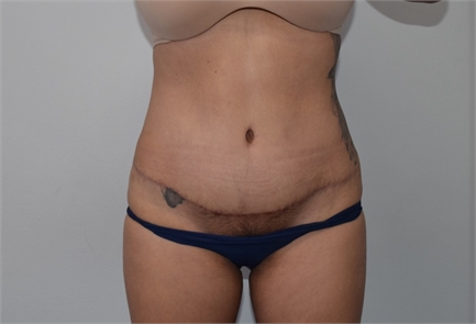 los angeles tummy tuck  After