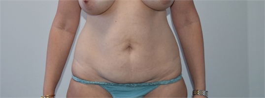 tummy tuck abdominoplasty Before