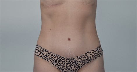 tummy tuck abdominoplasty After