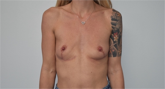 secondary breast augmentation Before