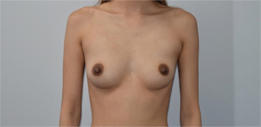 breast augmentation Before