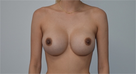 breast augmentation After