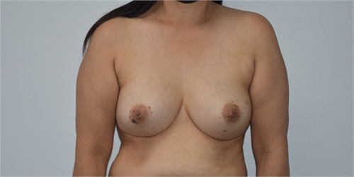 Breast implant removal Before