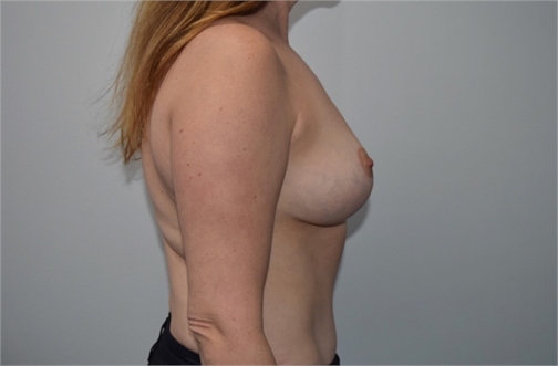 breast lift mastopexy with mesh After