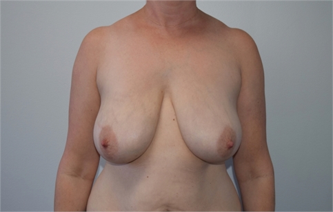 breast lift mastopexy with mesh Before