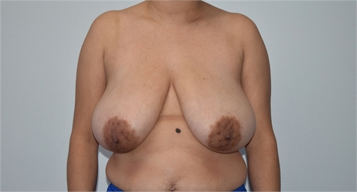 breast reduction with mesh Before