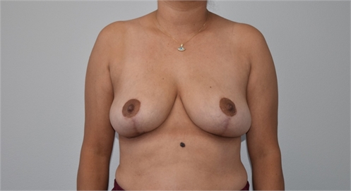 breast reduction with mesh After