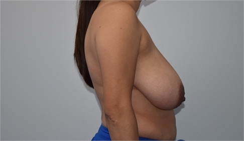 breast reduction with mesh Before