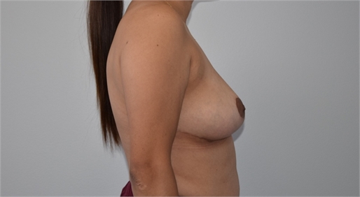 breast reduction with mesh After