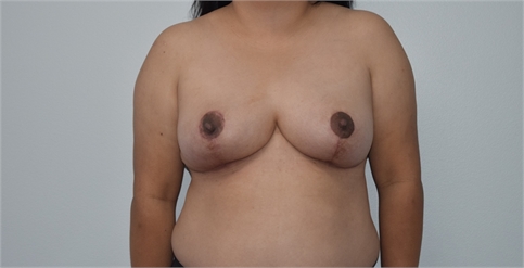 breast reduction After