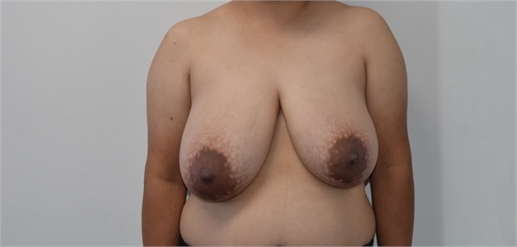 breast reduction Before