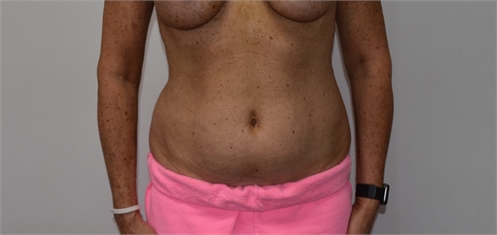 liposuction Before