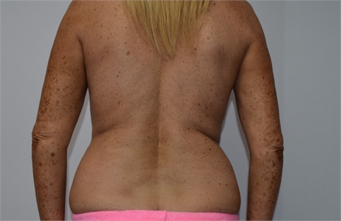 liposuction Before