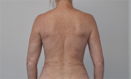 liposuction After