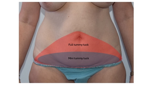 Tummy Tuck Austin