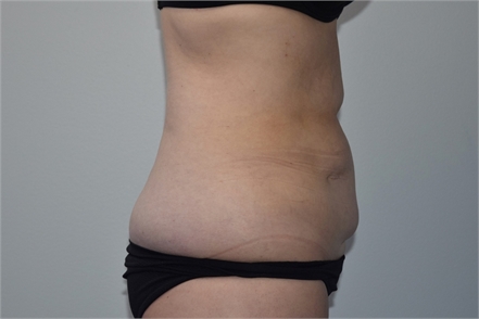 Mini tummy tuck Before