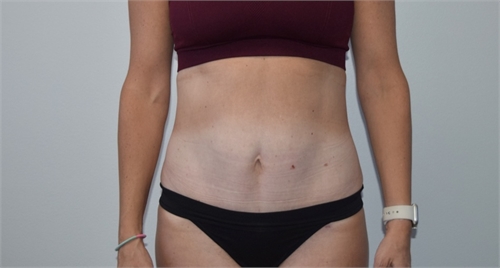 Mini tummy tuck After