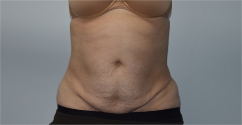 Mini tummy tuck Before