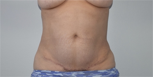 Mini tummy tuck After