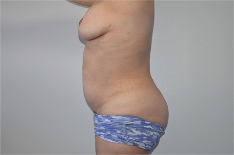 Mini tummy tuck After