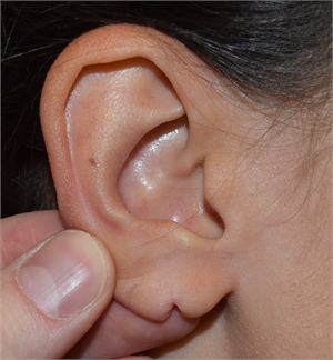 Ear Hole Repair / Ear Lobe Repair / Torn Ear Repair / Ear Pasting
