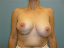 double bubble breast implant