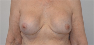 Breast Implant Revision Los Angeles