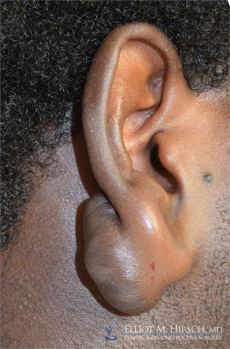 Los angeles keloid treatment patient Before